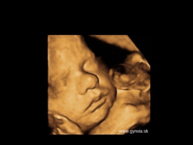 3D ultrazvuk | GYNVIA