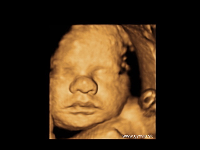 3D ultrazvuk | GYNVIA